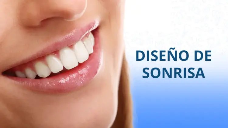 Diseño de sonrisa en Mazatlán Diseño de sonrisa en Mazatlán